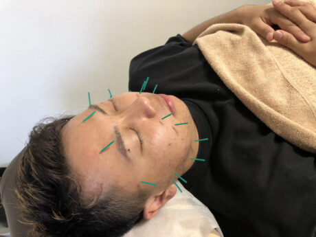 【美容鍼】筋肉はどうなる？