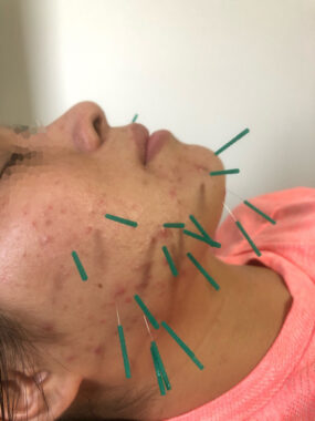 【治療】大人ニキビ