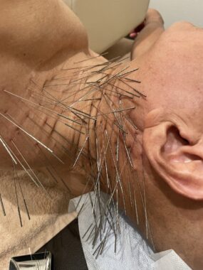 【ルート治療】効果について