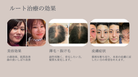 ルート治療に興味のある方へ